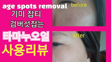 타마누오일 사용리뷰 기미지우개 #age spots removal #타마누오일#기미제거#기미없애는법#색소침착