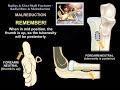 Radius Ulnar Shaft Fx Radial Bow & Malreduction  - Everything You Need To Know - Dr. Nabil Ebraheim