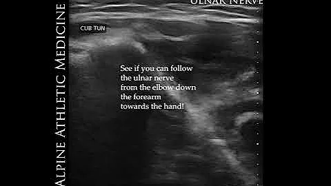 Ulnar Nerve Entrapment: Image-Guided Minimally-Inv...