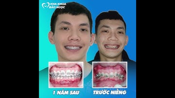 niềng răng sẽ thay đổi khuôn mặt như thế nào