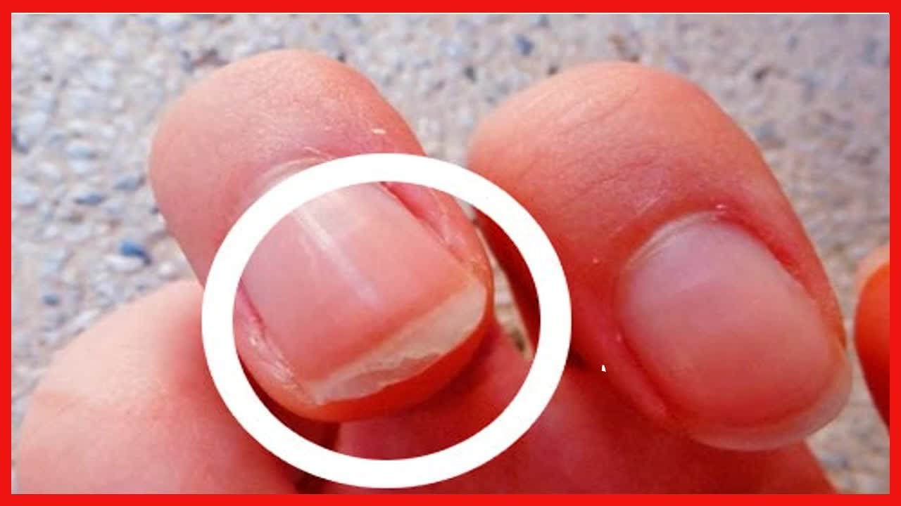 Rissige und splitternde Nägel - Ursachen, Behandlungen und Lösungen