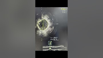 Percutaneous Coronary Intervention (PCI) is optimized with FFR and IVUS guidance for the LAD & Diag