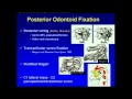 Dr.Azmi Hamzaoglu - Odontoid Fractures