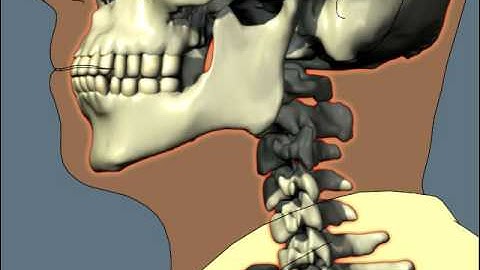 High Impact Rear-End Collision neck injury