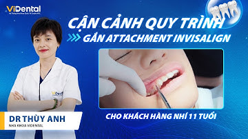 Quy Trình Gắn Attachment Cho Khách Hàng Nhí Niềng Invisalign | DR Thùy Anh
