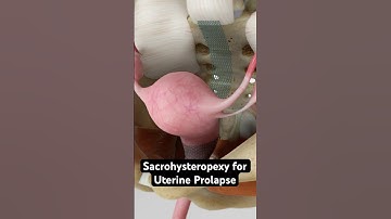 Restoring a fallen uterus (3D animation)