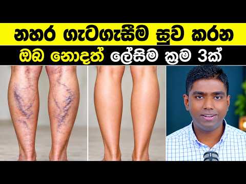 කකුල් වල නහර ගැටගැසීම (Varicose) සුව කරන ප්‍රායෝගික රහස් 3ක්