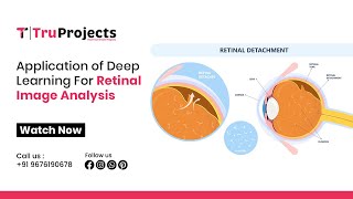 Application of deep learning for retinal image analysis II PYTHON IEEE PROJECTS IN HYDERABAD