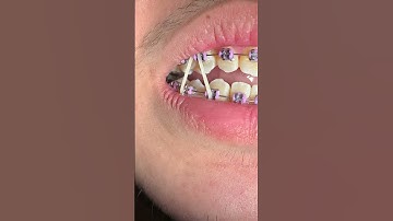 Thun liên hàm được gắn vào răng như thế nào và có tác dụng gì trong quá trình niềng răng?