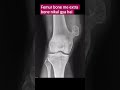 how to this possible comment kare, femur bone exta #radiologyshorts #anatomy #radiology #radiologist