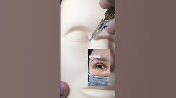 Mở khoé mắt trong được thực hiện thế nào?