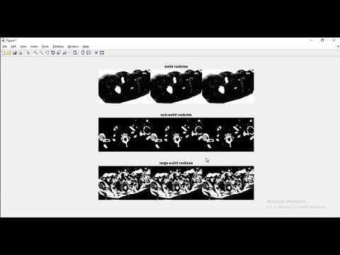 Pulmonary Nodule Detection in CT Images Project | Pulmonary Nodule Detection in CT Images Thesis