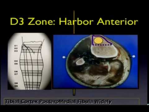 Nailing of Proximal Tibial