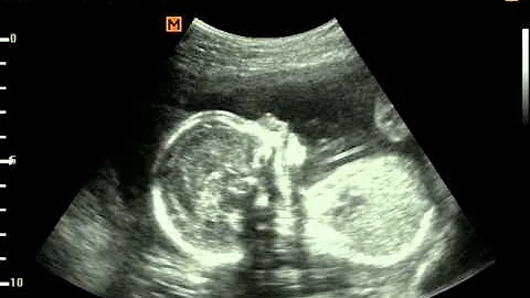 Amy Dees second baby ultrasound