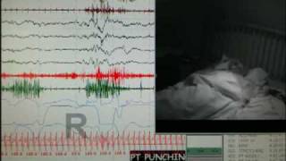 REM Behavior Disorder occurring in a sleep disorders center. Find o...