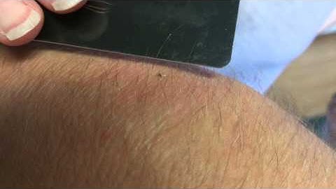 Properly Remove a Honeybee Stinger
