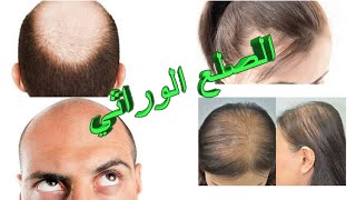 تساقط الشعر - الصلع الوراثي - نقاط جوهرية ومختصرة