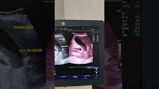 Gallbladder Sludge. Ultrasound