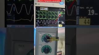 What is Temporary pacemaker l What is Temporary pacemaker l TPI #heartblock #shorts