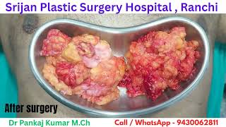 Gyno surgery| Best Gynecomastia surgery in Ranchi| Scarless Gynecomastia treatment in Ranchi #gyno