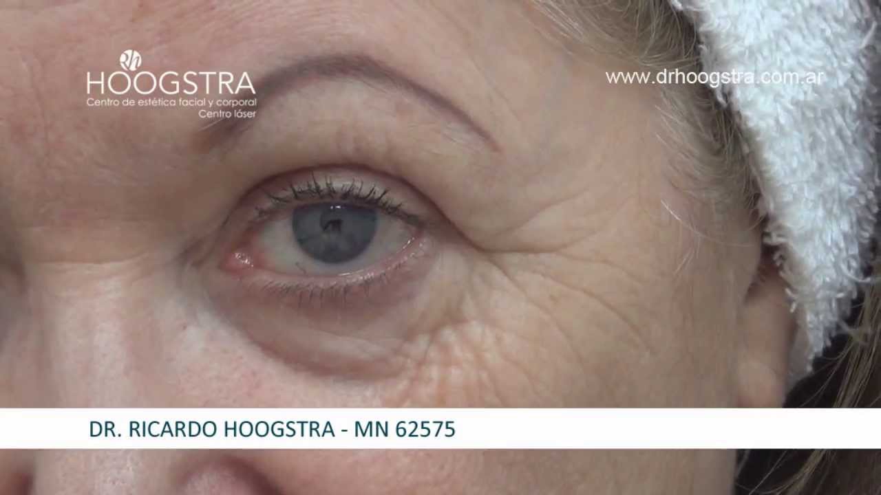 botox meaning Rejuvenecimiento Facial con Láser CO2 y toxina botulínica (14005)