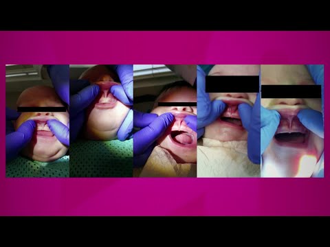 Video: Kapan diagnosis ankyloglossia?