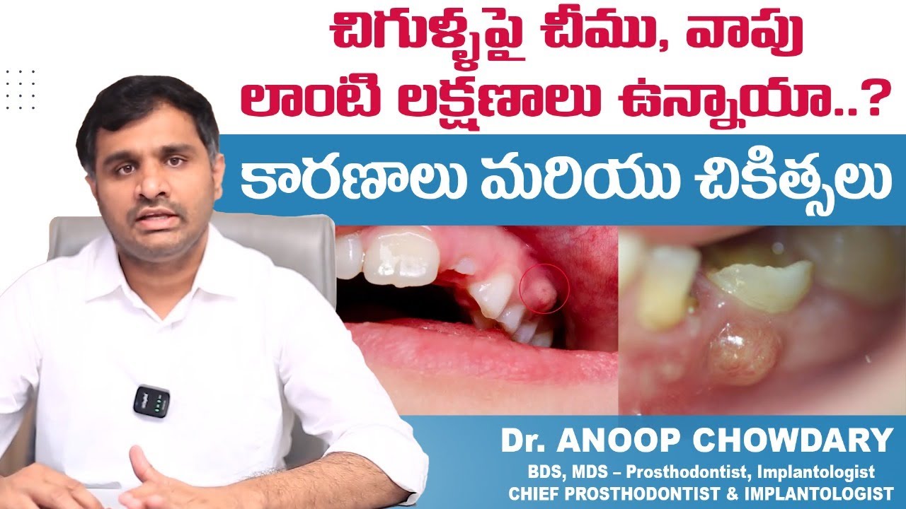 చిగుళ్ళపై చీము, వాపు లాంటి లక్షణాలు ఉన్నాయా || Dental Abscess in Telugu || Expert Dental Care