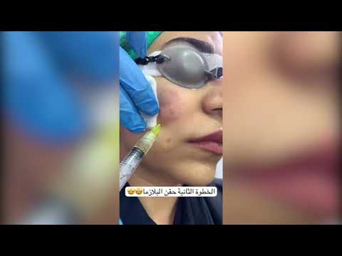(Subcision) تقنية تقطيع الألياف لعلاج الندبات وحفر حب الشباب العميقة