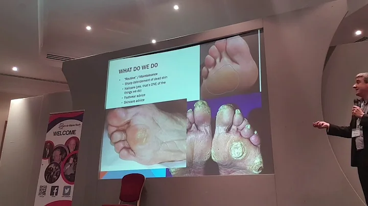 Podiatry for CMT. Robert Isaacs at the CMT UK 2019...