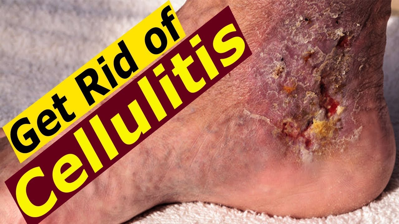 beautycon How to Treat Cellulitis - 7 Most Effective Home Remedies.