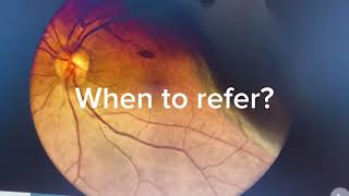 Retinal Detachment: Mac ON