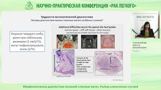 Морфологическая диагностика опухолей слюнных желез. Разбор клинических случаев