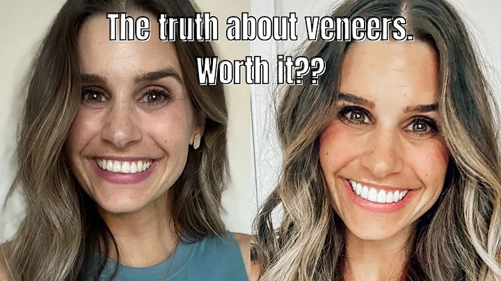 The truth about veneers! Are they worth it??