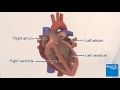 Heart arrhythmias - ventricular fibrillation