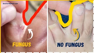 How to GET RID of the Athletes Foot Fungus Forever (This is how I did it at home)