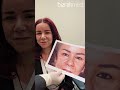 Outstanding outcome | Blepharoplasty & Rhinoplasty |14 days Post-OP |Dr. Bizrah |London/Dubai/(1105)
