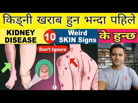क ड न ब ग र न भन द पह ल ह म ल ई कस त लक षणहर द ख न छ Early Symptoms Of Kidney Failure 