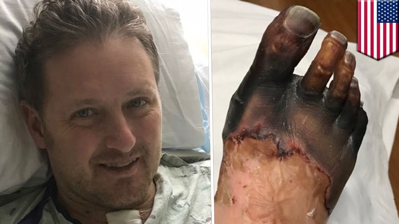 Rare Diseases Unusual Strep Throat Case Causes Michigan Dad To Lose Rare Diseases Unusual Strep Throat Case Causes Michigan Dad To Lose