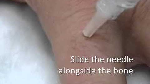 Digital Nerve Block Technique