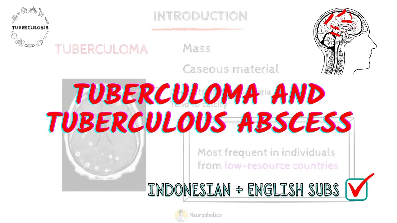 Tuberculoma vs Tuberculous Abscess Symptoms, Diagnosis, and Treatment