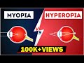 Difference Between Myopia and Hyperopia | Near and Farsightedness | Physics | Letstute