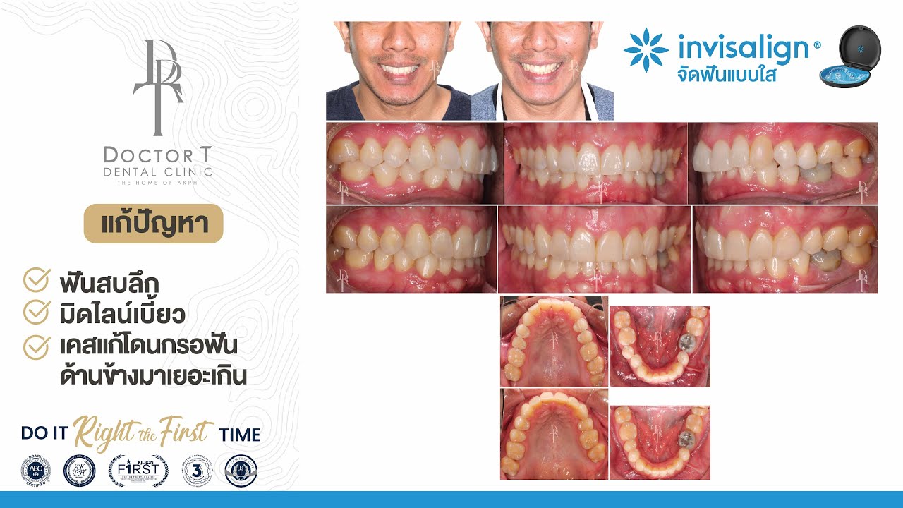 Before - After 𝗜𝗻𝘃𝗶𝘀𝗮𝗹𝗶𝗴𝗻 แก้ปัญหาสบฟันลึก แพลนผิดมิดไลน์เบี้ยว เคสแก้โดนกรอฟันด้านข้างมาเยอะ