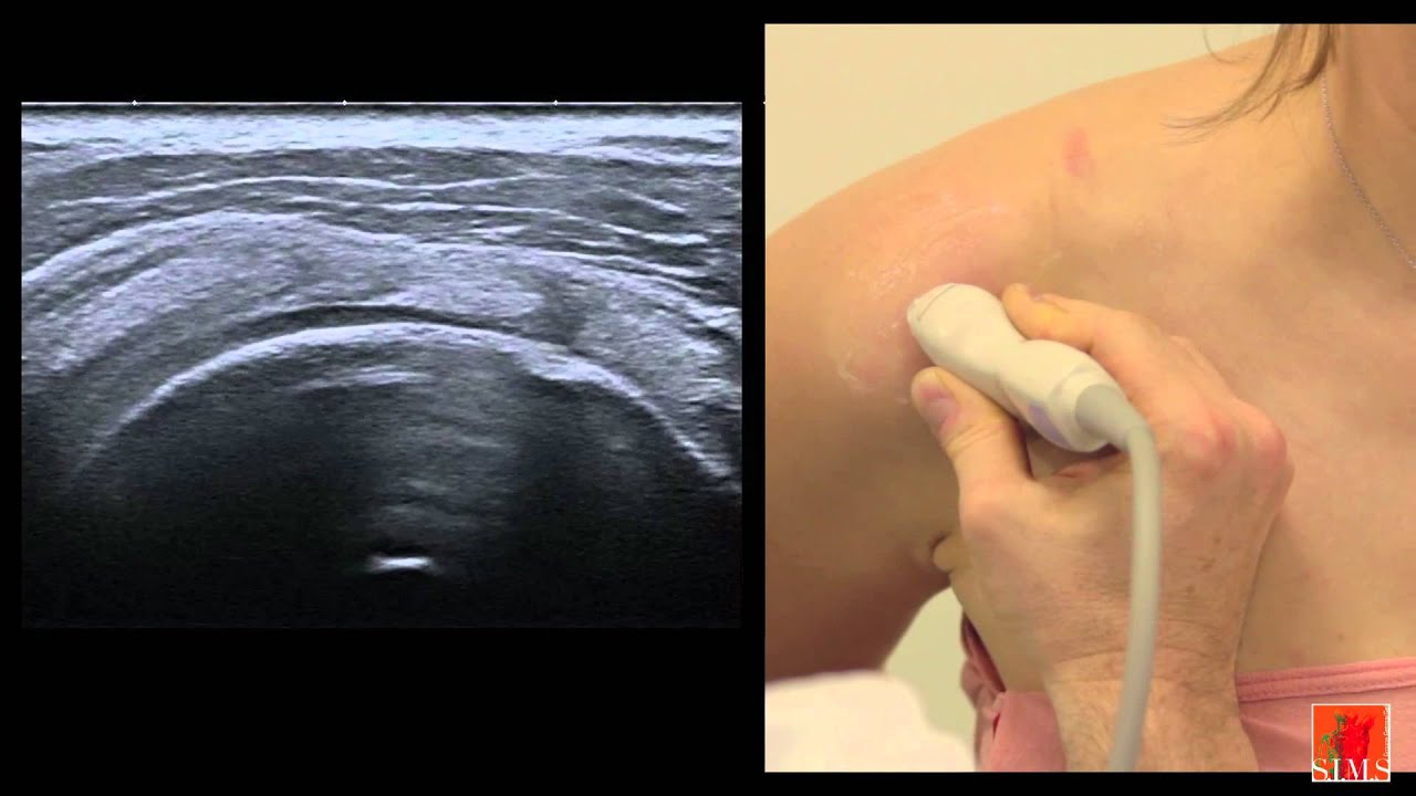 Échographie de l'épaule II