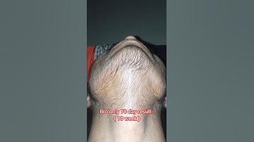 Natural beard growth journey man matters minoxidil beardmax 5% #viralshorts