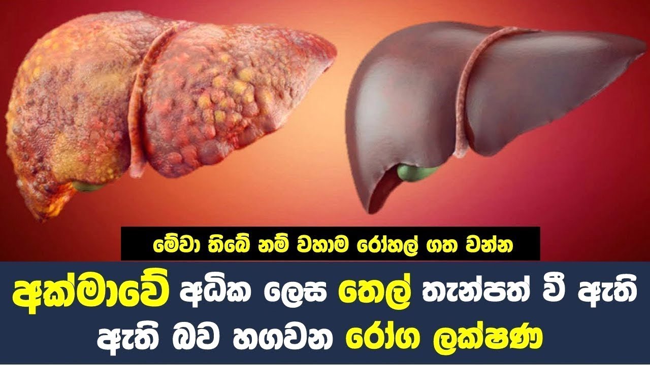 අක්මාවේ අධික ලෙස තෙල් තැන්පත් වී ඇති බව හගවන රෝග ලක්ෂණ How to Have a