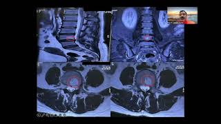 Difference between Modic changes &amp; Hemangioma in vertebral body. Update on How to read MRI of spine
