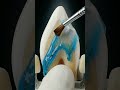 Broken Front Tooth 🦷 Watch This Repair Transform #dentalcare #dentist #teethdecay #oralhealth
