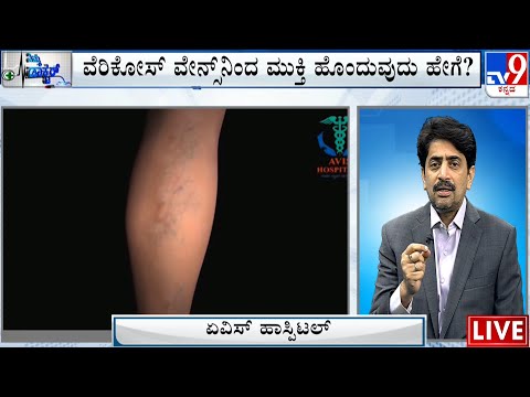 Nimma Doctor | Treatment For Varicose Veins | AVIS Hospital (22-11-2023)