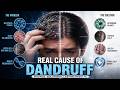 Demystifying Dandruff 🧴 The Real Cause No One Talks About