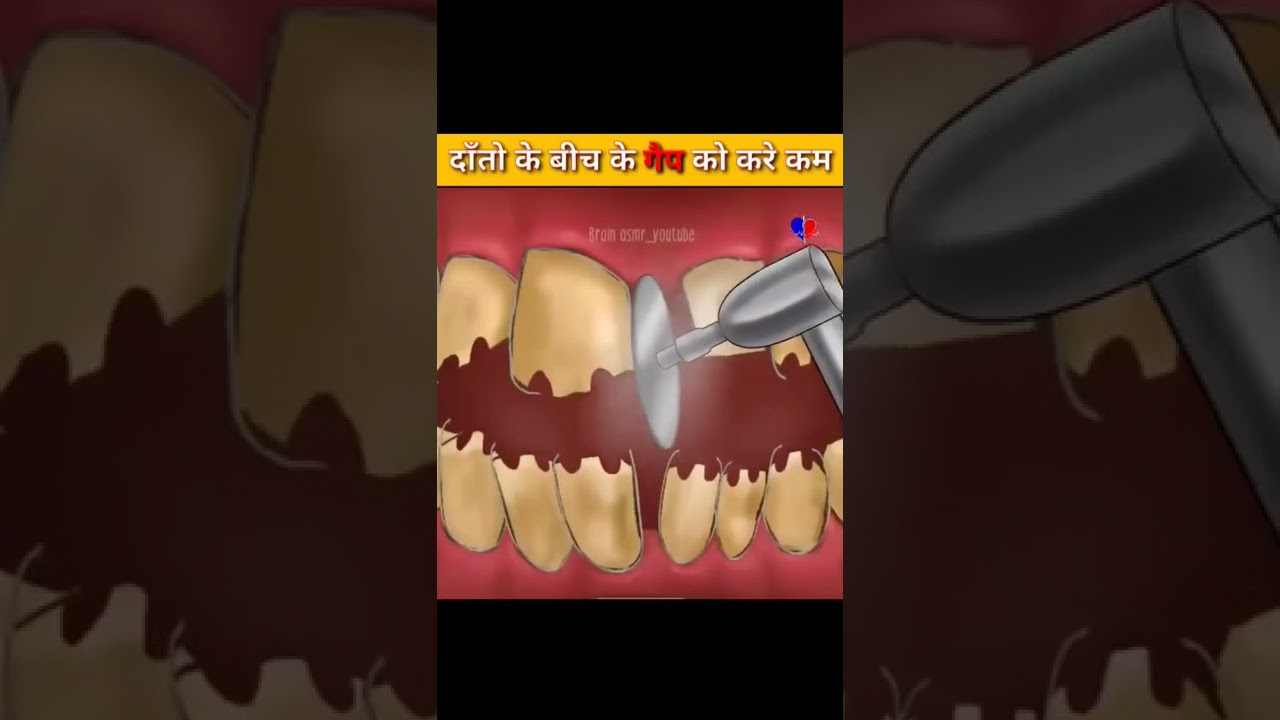 दाँतो के बीच के गैप को कैसे कम करे || How to fill gap between Teeth || Prateek || Medical Mitra